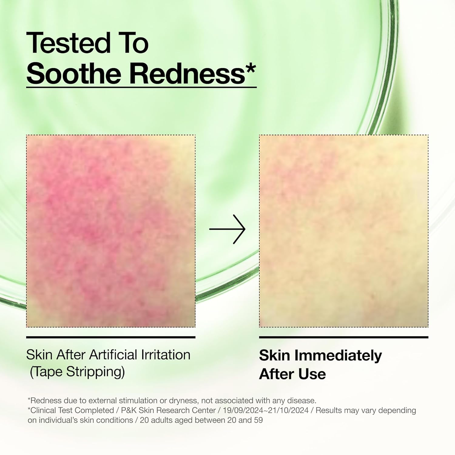 ANUA 10+AZELAIC ACID HYALURON REDNESS SOOTHING SERUM