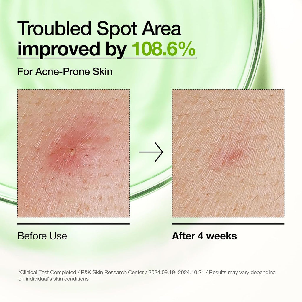 ANUA 10+AZELAIC ACID HYALURON REDNESS SOOTHING SERUM