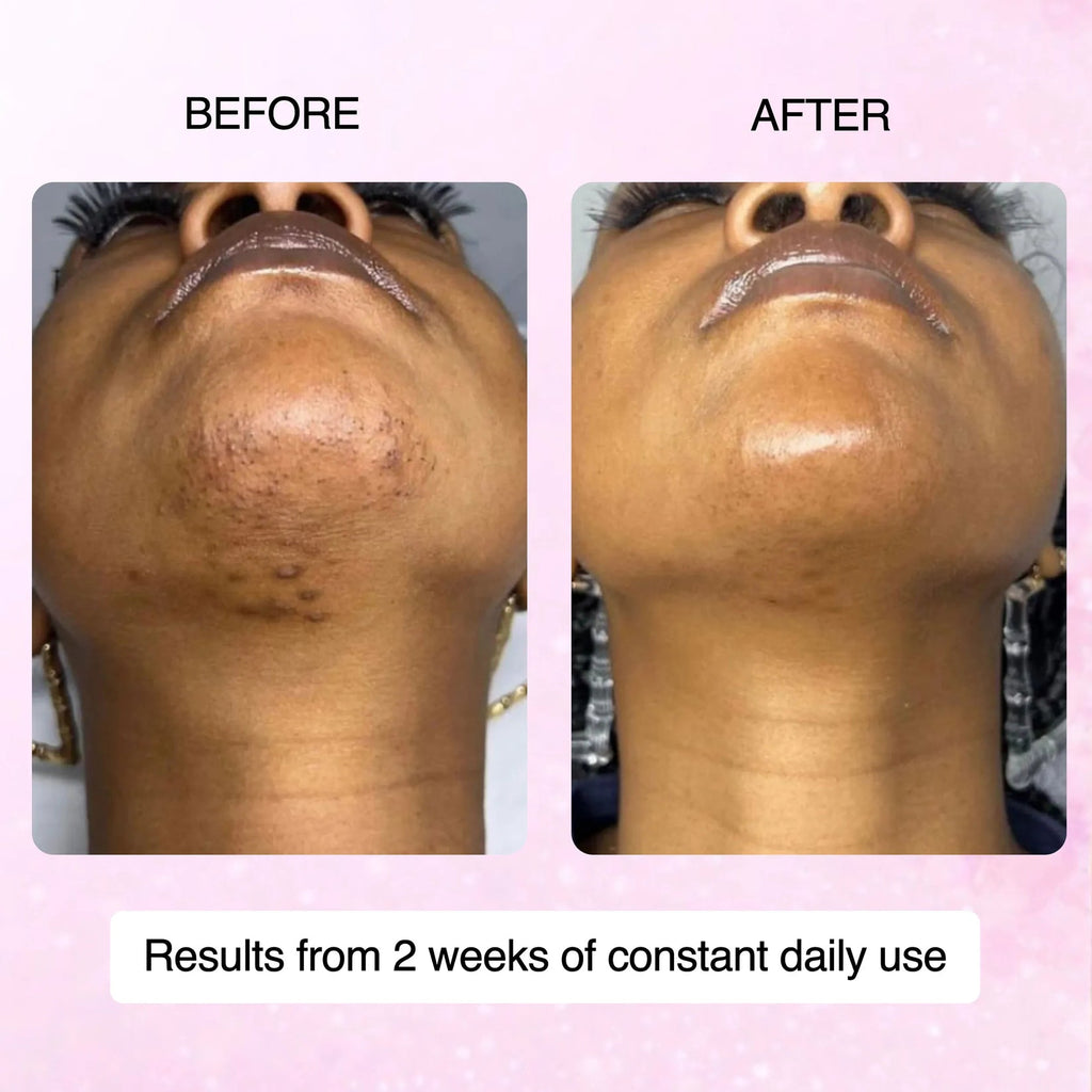 Cyperus Rotundus Hair Removal Oil